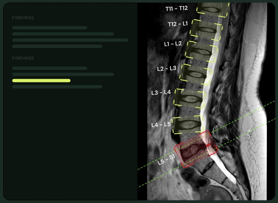 Evidence-linked findings — MRI with labeled vertebrae levels