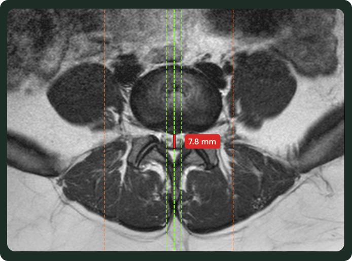 CT scan with pre-marked AI measurements annotated directly on the DICOM image